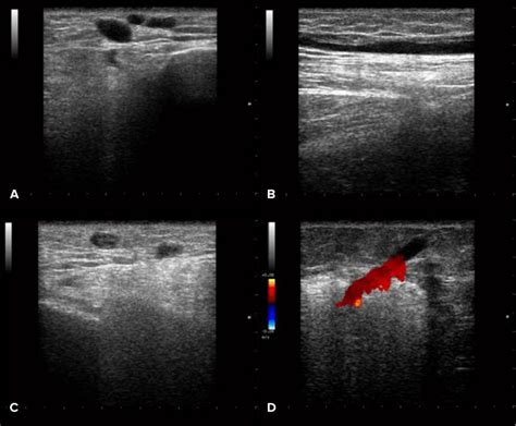 Left Lower Limb Venous Ultrasound B Mode And Doppler Important
