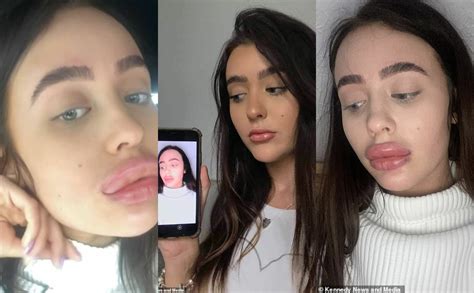 Ladys Lips Triple In Size After Botched Lip Filler Treatment Photos Theinfong