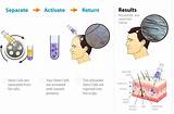 Stem Cell Treatment For Hair Loss Side Effects Photos