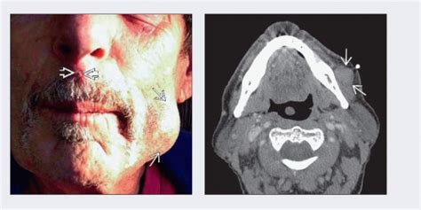 Merkel cell carcinoma is different from other skin cancers in that it does not have a common identifiable trait across all cases. Merkel Cell Carcinoma, Skin | Radiology Key