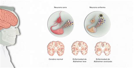 Enfermedad De Alzheimer PortalclÍnic