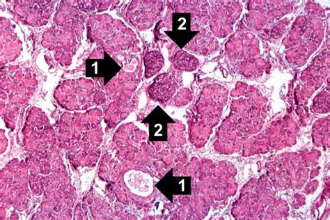 Cystic fibrosis is an autosomal recessive disorder, and most carriers of the gene are asymptomatic. Cystic fibrosis pathophysiology - wikidoc