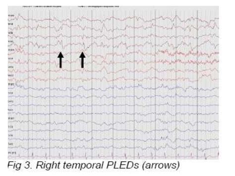 Periodic Lateralizing Epileptiform Discharges