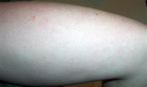 How To Get Rid Of Bumps On Arms Hubpages