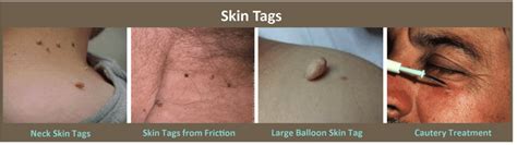This skin tag remover is an especially great option for anyone who's been frustrated in the past by ineffective skin tag removal creams and devices. Skin Tags Removal Plano TX | Acrochordon Treatment Frisco, TX