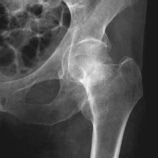 93 Hip Fractures | Radiology Key