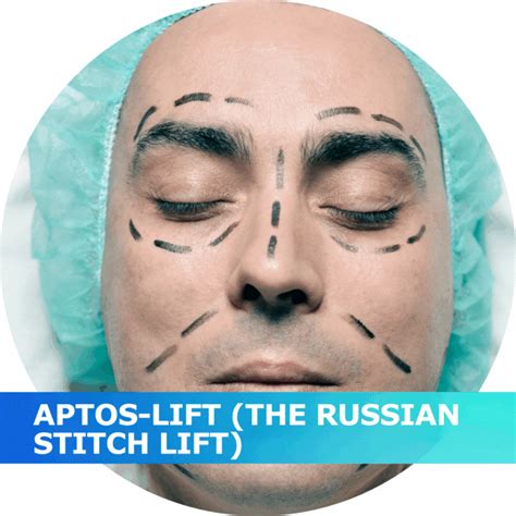 These flaps heal well with good sensation due to robust blood supply and innervation. Aptos Lift - Faloplastia Guadalajara Mexico