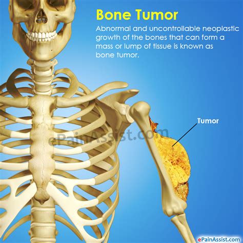 You'll often see it on your face, head, or neck. Bone Tumor|Types|Symptoms|Treatment|Survival Period