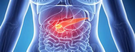 A pancreatite aguda é uma inflamação no pâncreas. Pancreatitis Síntomas y diagnóstico