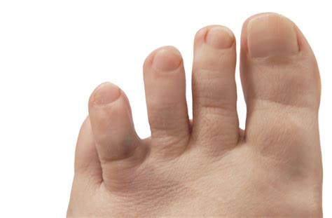 Broken Toe Symptoms Pictures And Treatment