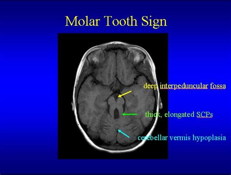 Joubert Syndrome Molar Tooth Midbrain Hindbrain