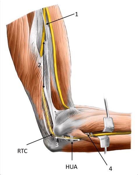 Possible Sites Of Compression Of The Ulnar Nerve At And Around The