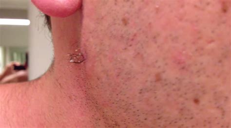 From preventing ingrown hairs to fighting acne, jack black razor bump and ingrown hair solution was made to nearly do it all. Man pulls out the longest ingrown hair in the history of ...