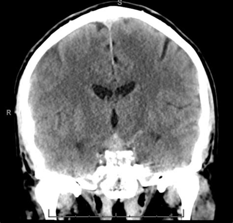 Subarachnoid Hemorrhage Radiology Case Radshare Net