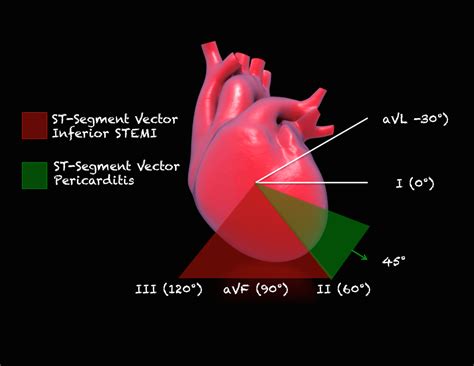 A clinical, echocardiographic, and hemodynamic evaluation of two surgical techniques. Inferior STEMI vs Pericarditis - REBEL EM - Emergency ...