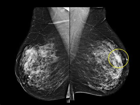 Mamografia Cancer De Mama