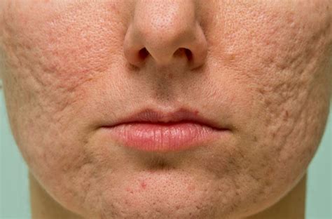 The Best Ways To Get Rid Of Acne Scars Cleveland Clinic