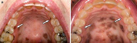 A Multifocal Brown Macules On The Hard Palate Showing Variation In