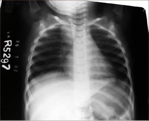 An X Ray Chest Showing A Right Paratracheal Soft Tissue Open I