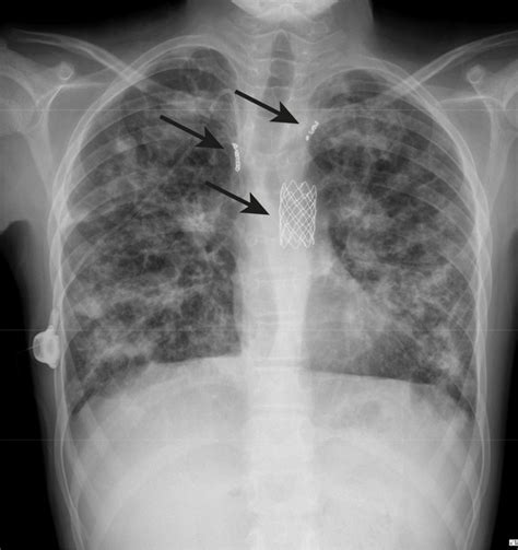 Learn about the diagnosis, symptoms, signs, treatment and prognosis for this genetic disease. Recurrent haemoptysis in a child with advanced cystic ...
