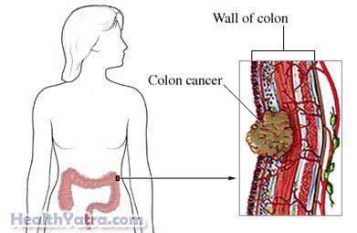 Persistent cramping, lower abdominal pain, and bloating and gas can be a sign, however, of colon cancer. Colon Cancer Definition, Causes, Symptoms, Complications ...