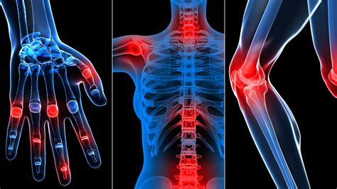 What is rheumatoid arthritis (ra)? Clínica de Reumatologia: Conheça a Clínica Croce ...