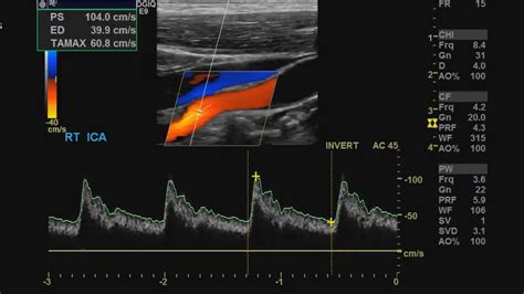 Carotid ultrasound is used to diagnose carotid artery stenosis (cas) and can assess atherosclerotic plaque morphology and characteristics. Pin on Vascular