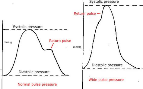 The type of ventilator and ventilator mode can have different effects on the pressure waveforms. icupearls.org Archive: 2017