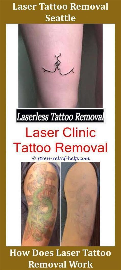 Here are a few of those articles to give you an idea of what is possible: Easy Tattoo Removal Does Tattoo Removal Work Reddit How To ...