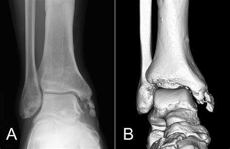 Proximal Avulsion Rupture Of The Flexor Digitorum Longus Tendon