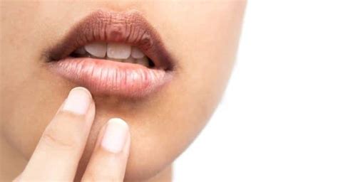 Tips To Get Rid Of White Spots On Lips