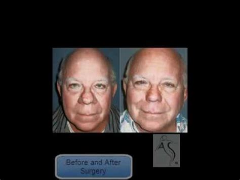 Rhinophym it eine form von roacea, die hauptächlich da ende der nae betrifft und eine extreme verdickung und rötung der haut veruracht. Rhinophyma - YouTube