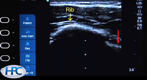 Image Ultrasound Appearance Of Ribs And Pleural Line Msd Manual