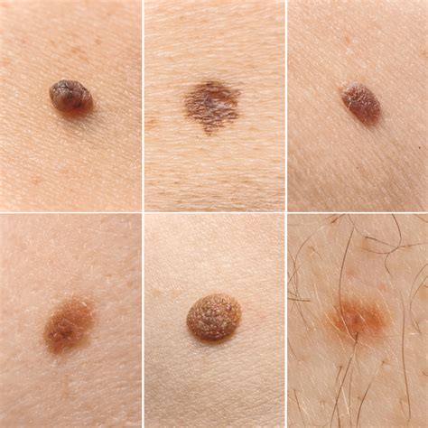 Understanding The Different Types Of Moles Spot Check Clinic