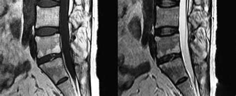 The Andersson Lesion In Ankylosing Spondylitis Bone And Joint