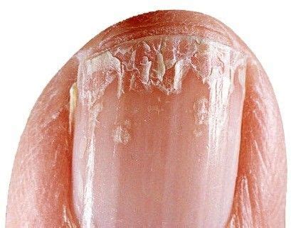 Other possible causes of brittle nails include vitamin deficiencies, thyroid disease, psoriasis, nail fungus or anemia. 12 Ways Your Fingernails Can Tell You About Your Health ...
