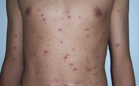 The best way to prevent chickenpox is to get the. The Chicken Pox Vaccine . . . . the Facts! | Kalmed Dispensary
