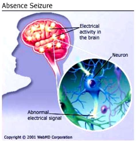 An Absence Seizure Causes A Short Period Of Blanking Out Or Staring