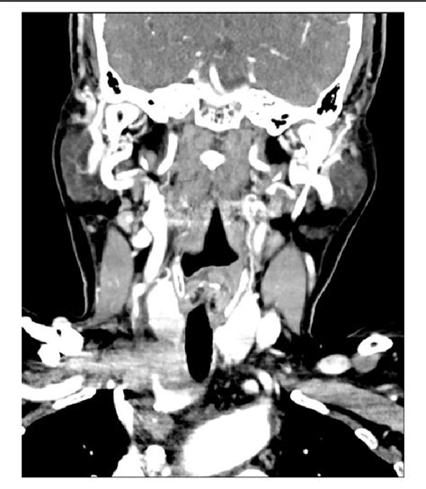 Figure 1 From Aggressive Thyroid Carcinoma Showing Thymus Like