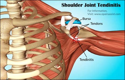 What Is Shoulder Joint Tendinitiscausessymptoms