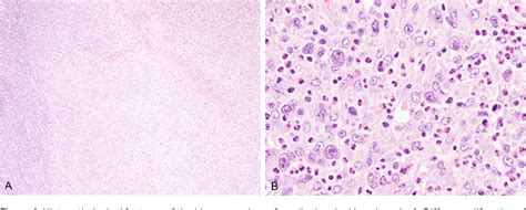 Figure 4 From Primary Cutaneous Anaplastic Large Cell Lymphoma