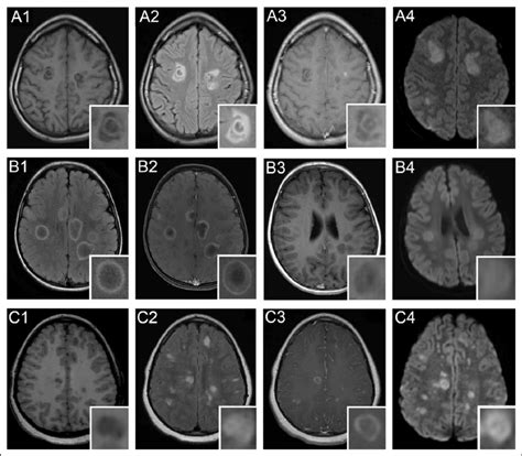 Brain Magnetic Resonance Imaging Mri A1 C4 Axial Brain Mri Slices