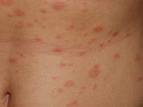 Pityriasis Rosea Skin Rash Photograph By Cnri Science Photo Library