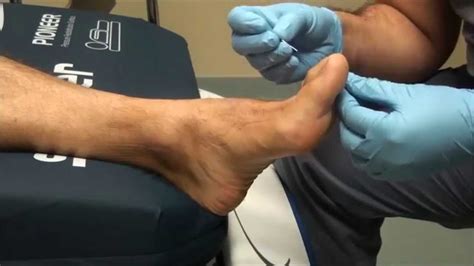 Neurologic Examination Of The Foot Pin Prick Testing