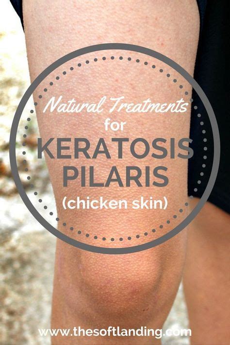 Natural Treatments For Keratosis Pilaris Chicken Skin Keratosis