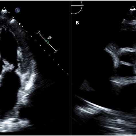 Transthoracic Echocardiogram A Apical Four Chamber View