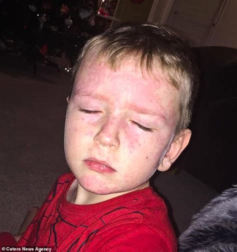 Seven Year Old With Rare Condition Breaks Out In A Rash Vomits And