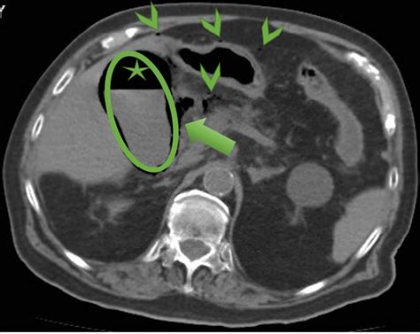 Acute Cholecystitis As Related To Abdominal Pain Pictures