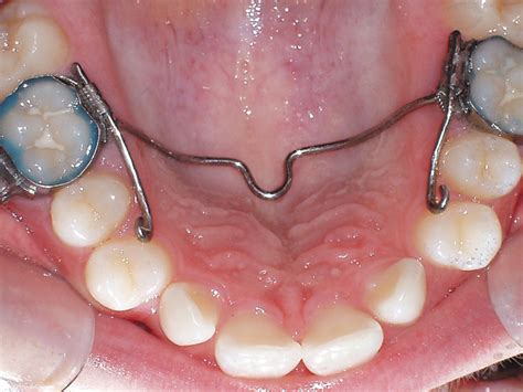 Orthodontic Procedures Austin Dentist Mike Williamson Dds Ms