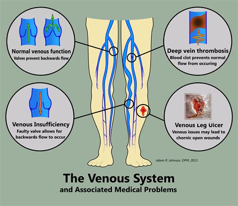 Vein Disease Symptoms